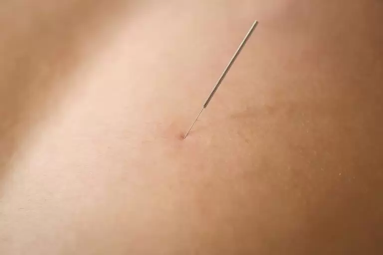 Aplicação de Dry Needling